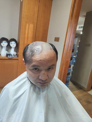 补发前秃顶 补发前秃顶