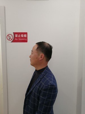 补发前侧面秃顶