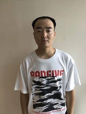 补发前发际线高效果 补发前发际线高效果