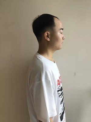 补发前侧面效果 补发前侧面效果
