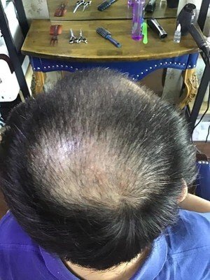 补发前头顶头发稀少 补发前头顶头发稀少