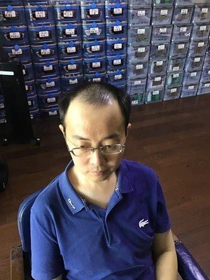 补发前M型脱发 补发前M型脱发