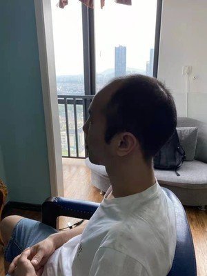 侧面发际线高+秃顶 侧面发际线高+秃顶