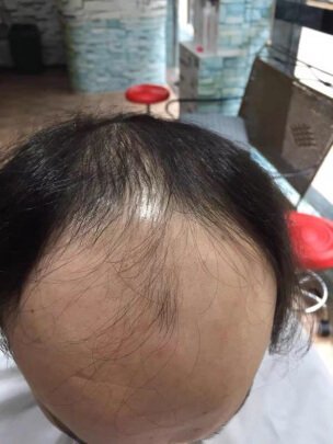 补发前前额高秃顶 补发前前额高秃顶