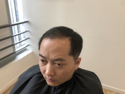 补发前发际线高呈M型