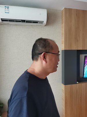 补发前头发稀少，秃顶