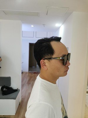 补发前额头发际线高:侧面效果 补发前额头发际线高:侧面效果