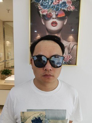 补发前额头发际线高 补发前额头发际线高