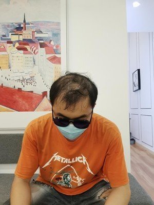 补发前头发稀疏——正面 补发前头发稀疏——正面
