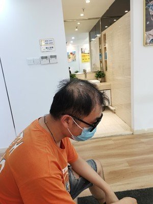 补发前头发稀疏——侧面 补发前头发稀疏——侧面