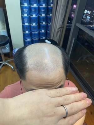 补发前秃顶效果