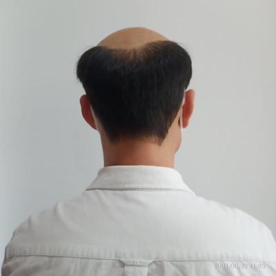 补发前秃顶——背面