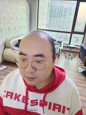 补发前秃顶严重 补发前秃顶严重