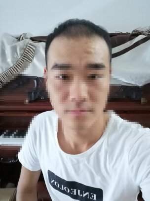 补发前额头高、头发稀少 补发前额头高、头发稀少