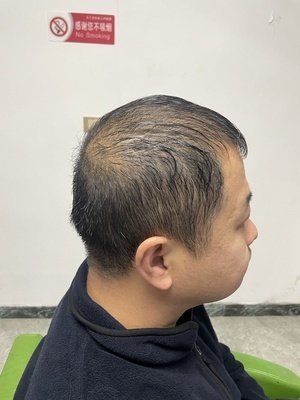 补发前头发稀少——侧面 补发前头发稀少——侧面