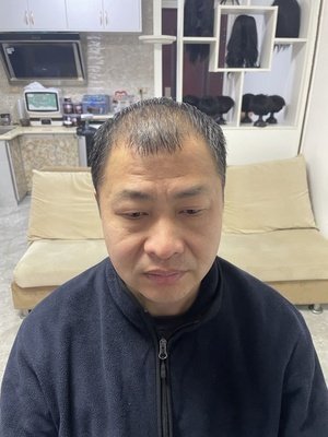 补发前脱发严重效果 补发前脱发严重效果