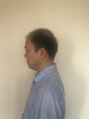 补发前侧面效果 补发前侧面效果
