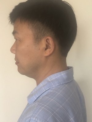 补发前侧面效果 补发前侧面效果