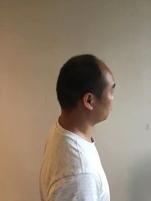 补发前侧后效果 补发前侧后效果