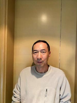 补发前正面发际线高 补发前正面发际线高