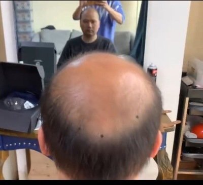补发前秃顶背面效果 补发前秃顶背面效果
