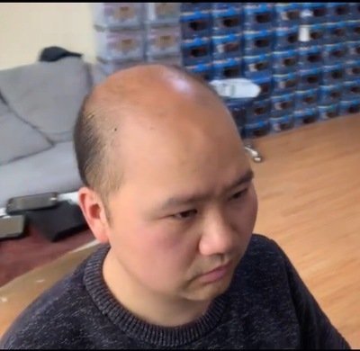 补发前秃顶 补发前秃顶