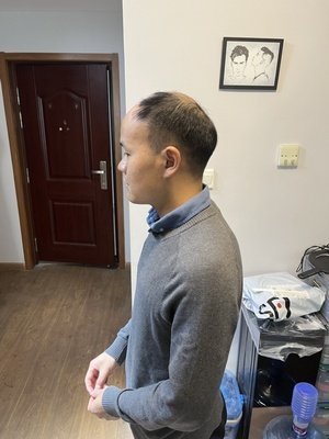 补发前秃顶,发际线高 补发前秃顶,发际线高
