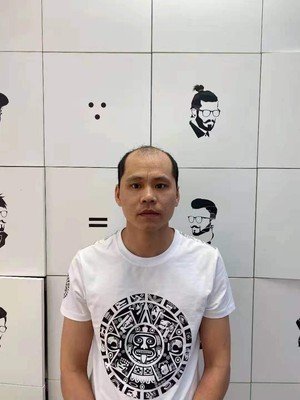 补发前正面：发际线高秃顶