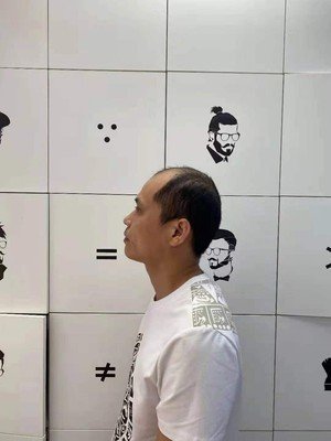 补发前侧面：发际线高秃顶