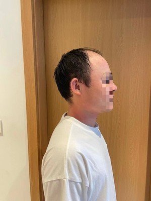 补发前侧面效果 补发前侧面效果