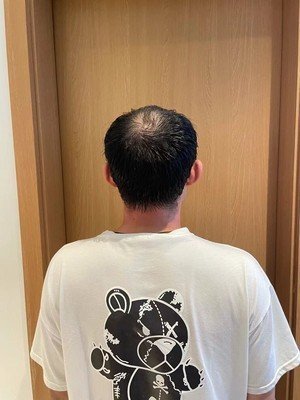 补发前秃顶背面效果 补发前秃顶背面效果