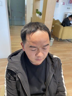 补发前，发际线高，显老
