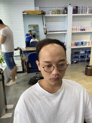补发前发际线高：正面