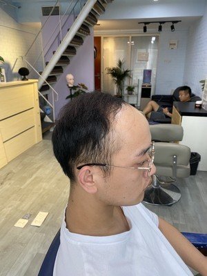 补发前发际线高：侧面