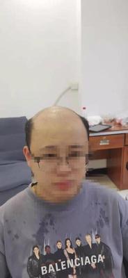 补发前秃顶 补发前秃顶