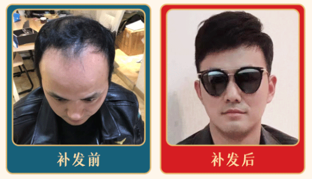 生物头皮补发前后效果对比 生物头皮补发前后效果对比