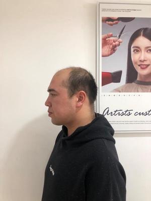 补发前发际线高秃顶:侧面 补发前发际线高秃顶:侧面