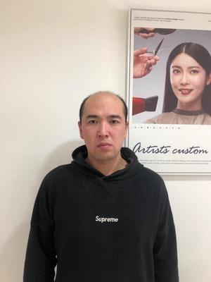 补发前发际线高秃顶:正面 补发前发际线高秃顶:正面