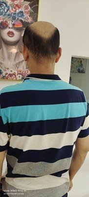 补发前秃顶:背面 补发前秃顶:背面