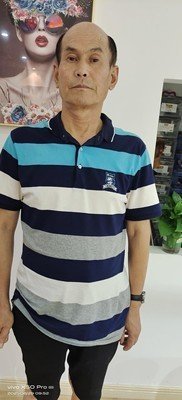 补发前秃顶:正面 补发前秃顶:正面