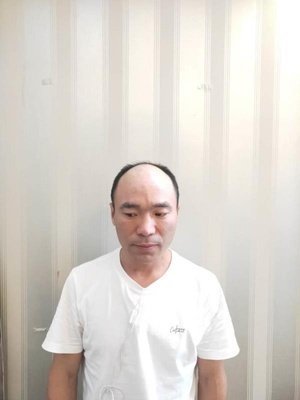 补发前发际线高秃顶 补发前发际线高秃顶