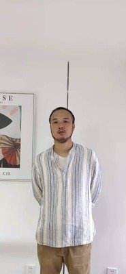 补发前发际线高正面效果