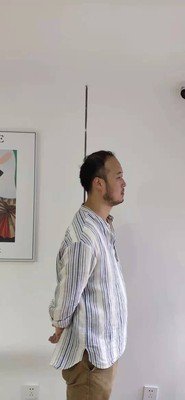 补发前发际线高侧面效果