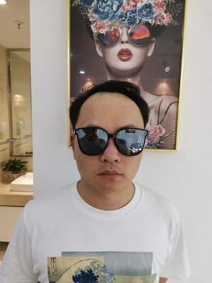 补发前正面效果:发际线高 补发前正面效果:发际线高