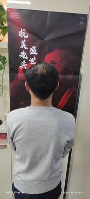 补发前秃顶,头发稀少,背面效果 补发前秃顶,头发稀少,背面效果