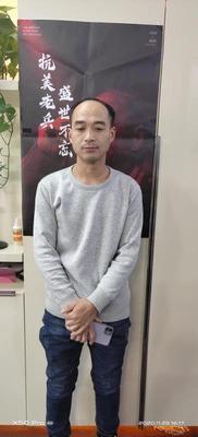 补发前前额发际线高,正面效果 补发前前额发际线高,正面效果