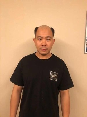 补发前秃顶 补发前秃顶