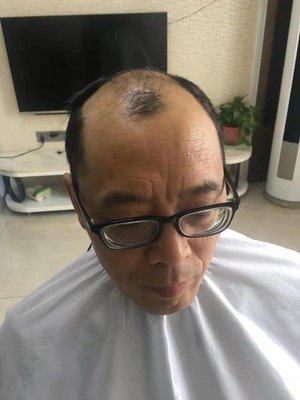 补发前前沿顶稀疏,秃顶 补发前前沿顶稀疏,秃顶