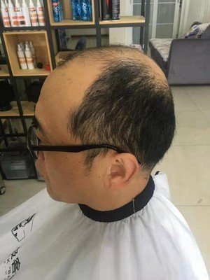 补发前侧面效果 补发前侧面效果