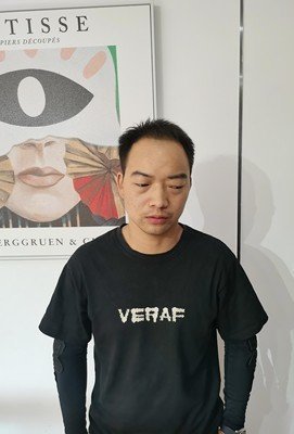 补发前发际线高 补发前发际线高